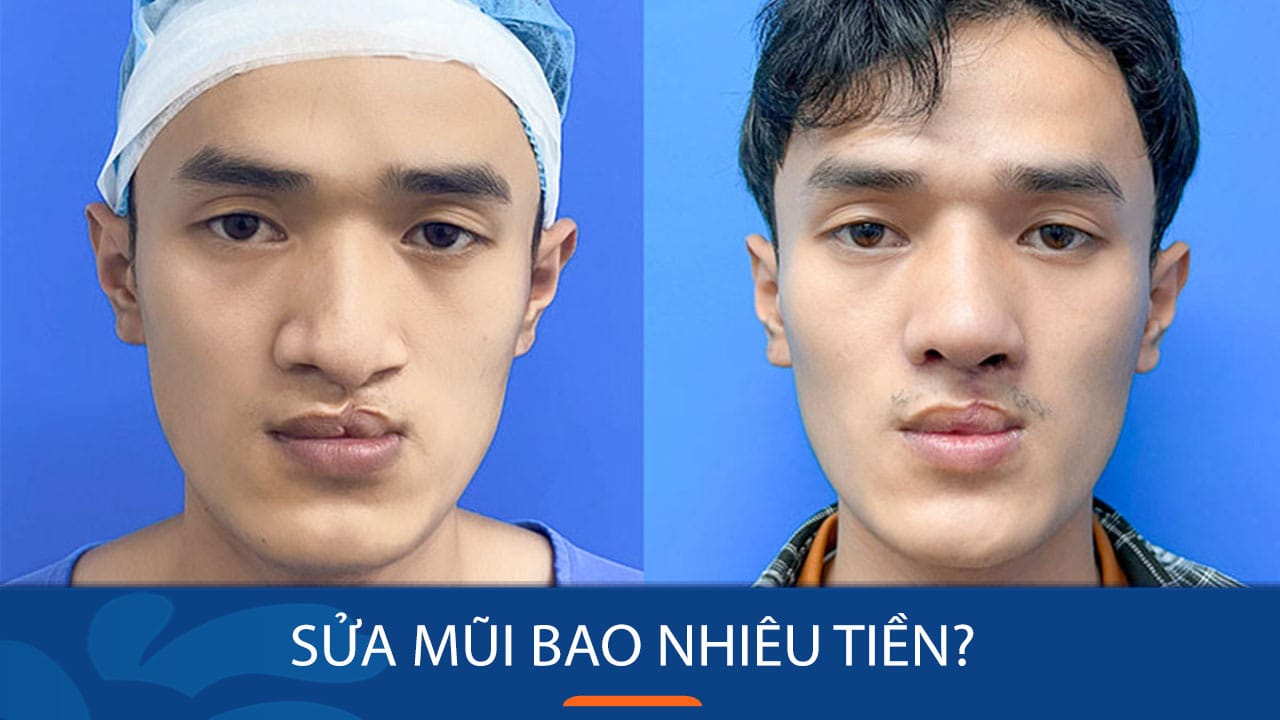 Sửa mũi bao nhiêu tiền? Bao lâu có thể sửa lại được