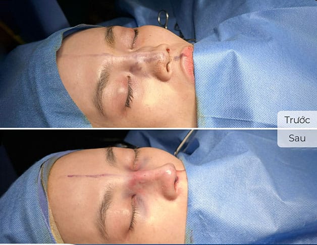 Cấu trúc mũi không còn nguyên vẹn sau mỗi lần chỉnh sửa