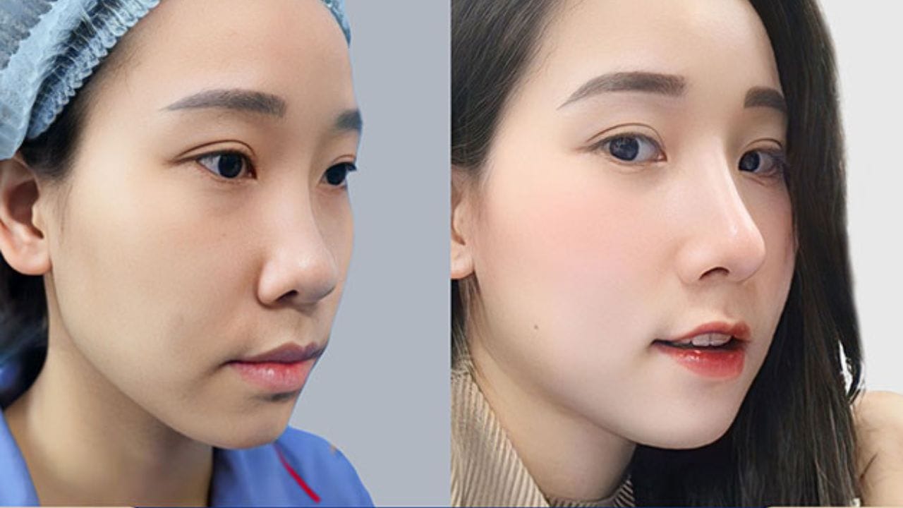 Sụn Surgiform giá bao nhiêu? Cập nhật bảng giá mới nhất