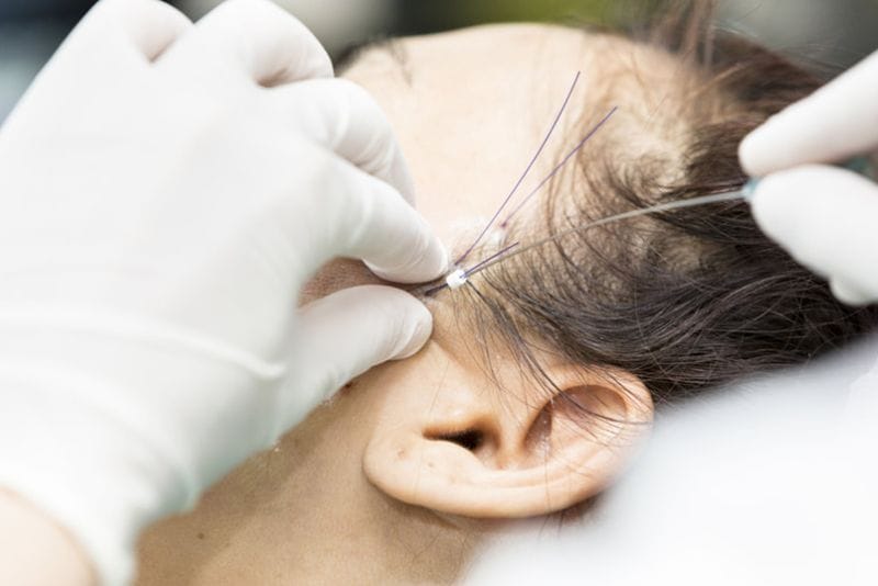 Người mắc bệnh lý về máu không nên cấy chỉ