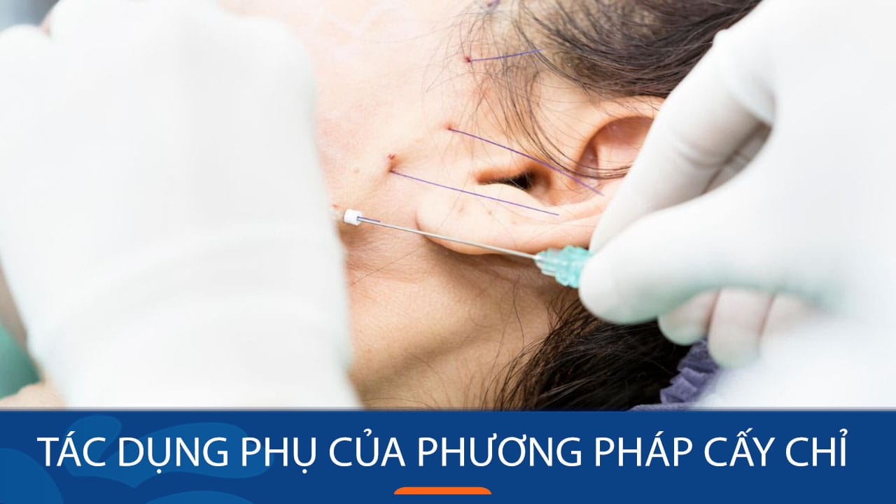 Cảnh giác với tác dụng phụ của phương pháp cấy chỉ