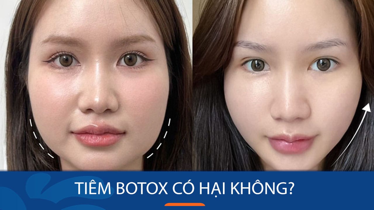 Tiêm botox có hại không? Giải mã sự thật từ chuyên gia da liễu