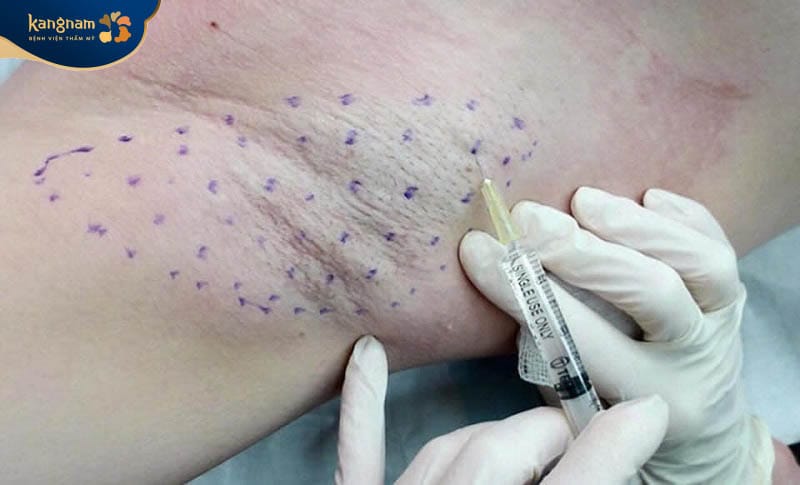 Cần tiêm botox nhắc lại vì hiệu quả không vĩnh viễn