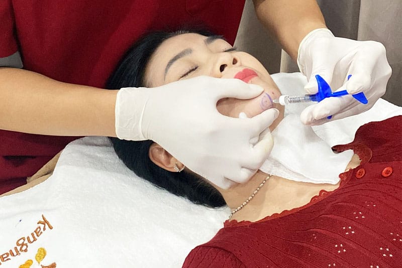 Thời gian filler vào form hoàn chỉnh tùy vào loại filler, vị trí tiêm và tốc độ ổn định của mỗi người