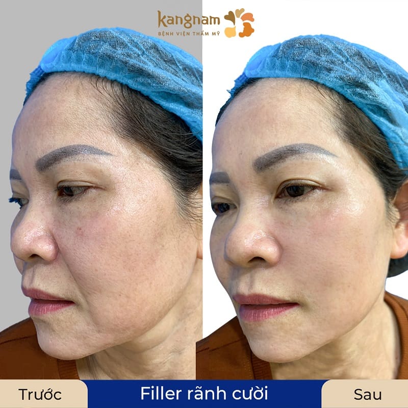 Tiêm filler giữ được khoảng 6-24 tháng