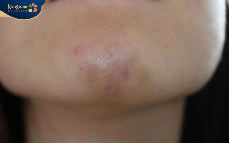 Vùng da bị sưng tấy và bầm tim sau tiêm filler