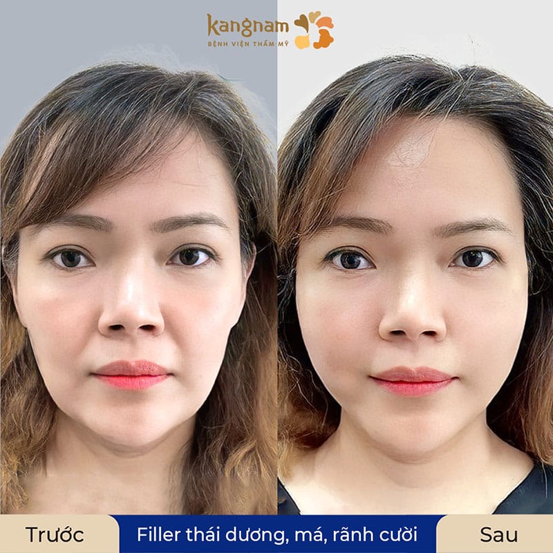 Những hiện tượng sau khi tiêm filler không ảnh hưởng đến kết quả