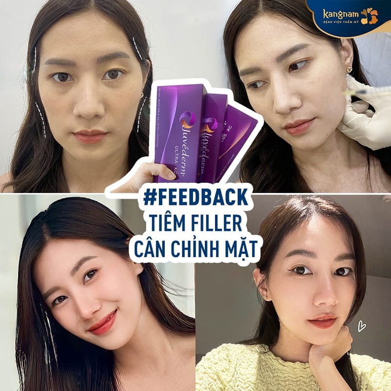 Khách hàng nên kiểm tra kỹ filler trước khi tiêm