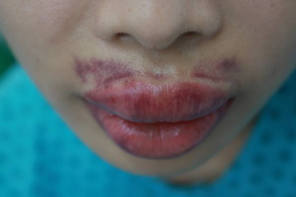 Sử dụng filler giá rẻ, kém chất lượng gây ra nhiều biến chứng nguy hiểm