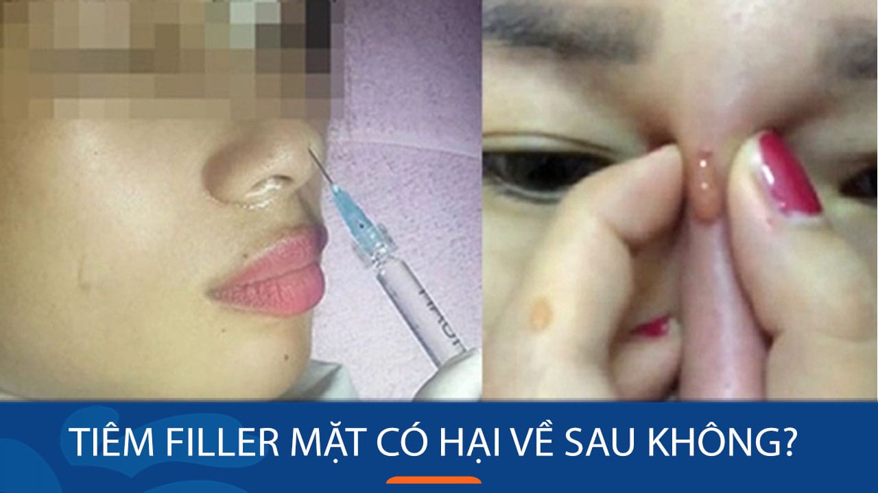 Tiêm filler mặt có hại về sau không? Cảnh báo các rủi ro tiềm ẩn