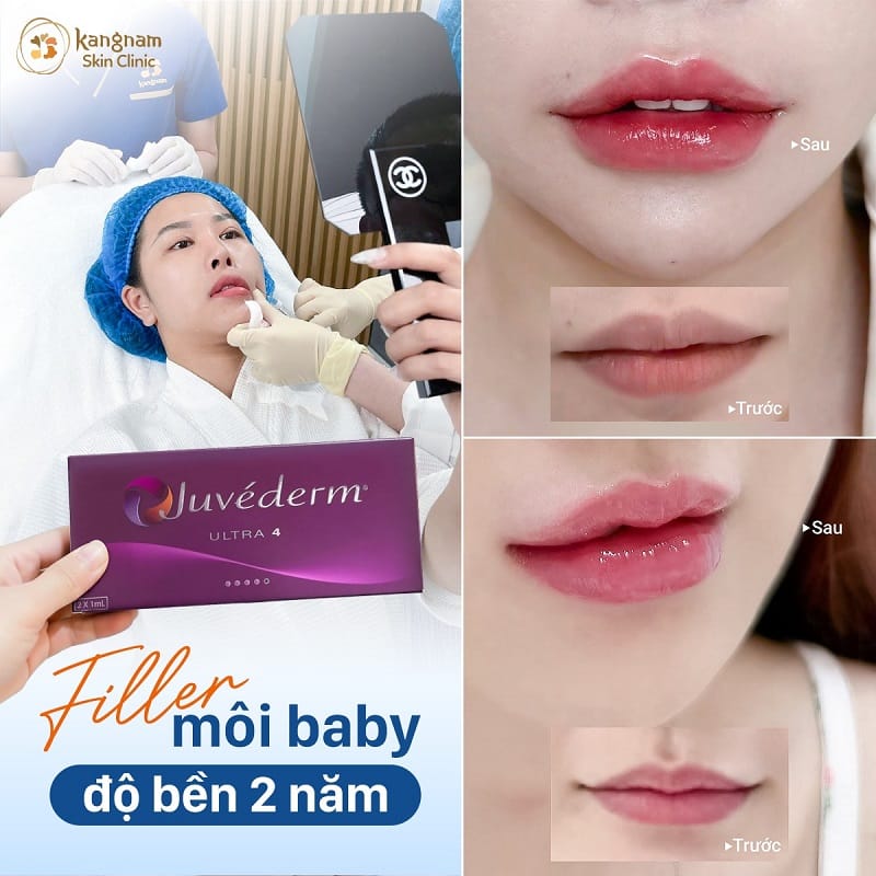 Kangnam cam kết sử dụng filler chính hãng, duy trì hiệu quả lâu dài