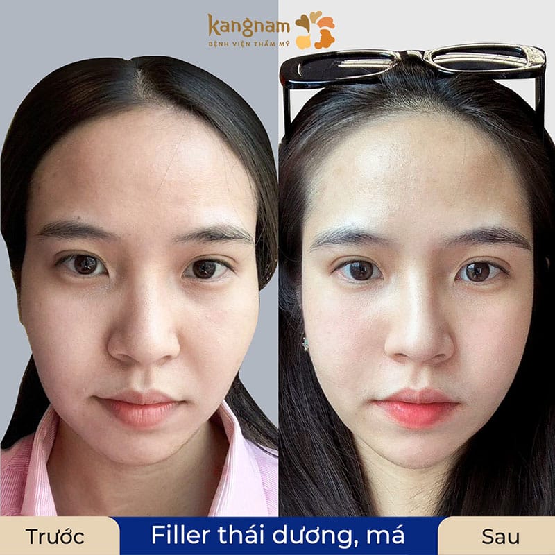 Chăm sóc đúng cách để có kết quả đẹp sau tiêm filler