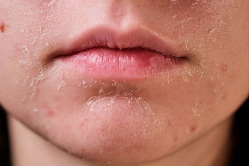 Da khô, mụn cần tần suất tiêm meso dày hơn