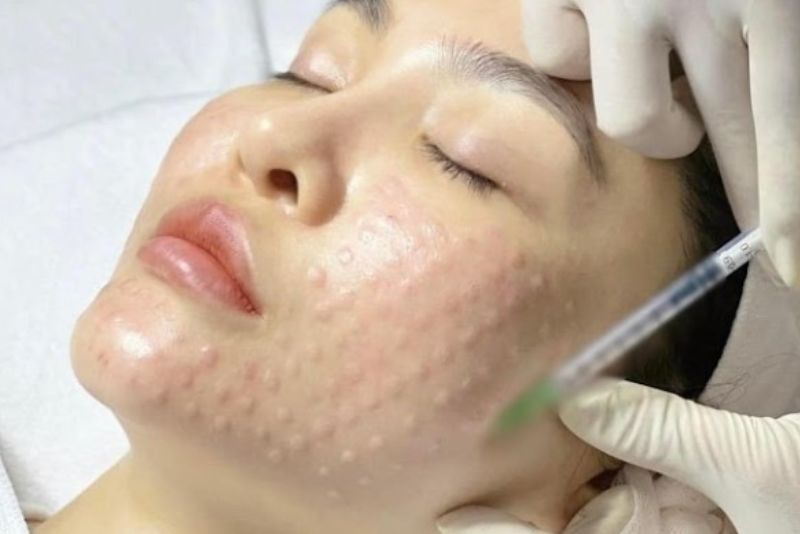 Việc để khoảng cách giữa các buổi tiêm meso là rất quan trọng vì làn da cần thời gian để hấp thụ hết dưỡng chất được đưa vào