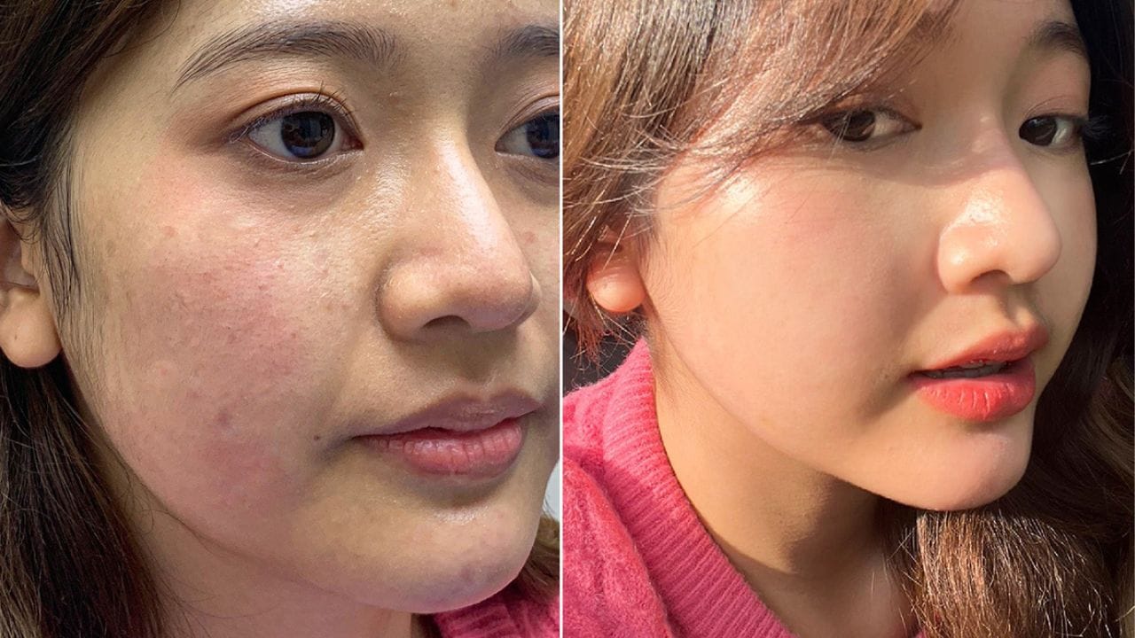 Tiêm meso bao lâu thì đẹp? cần lưu ý điều gì