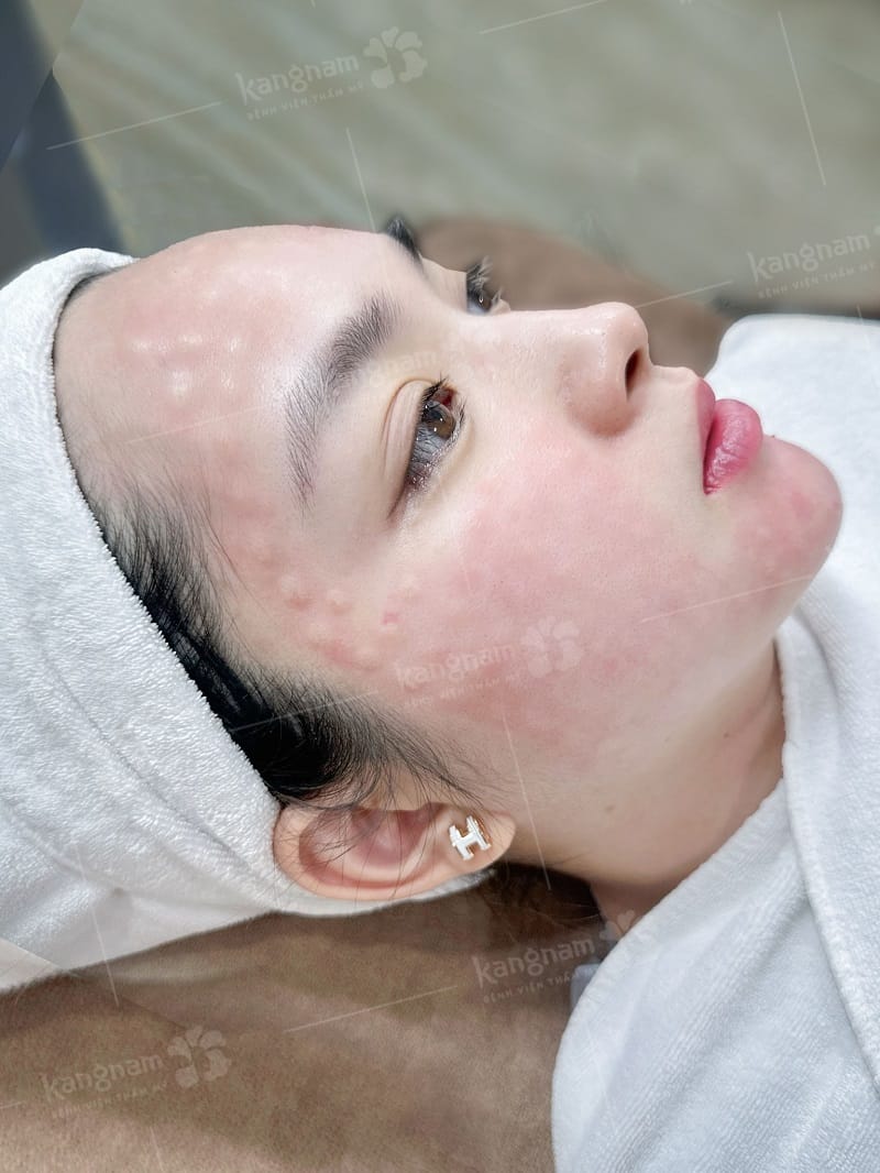 Da mặt sẽ đẹp sau vài ngày khi tiêm meso