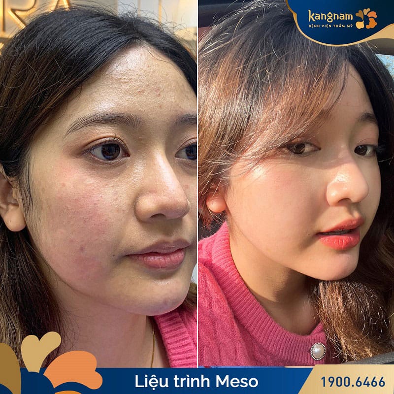 Mỗi làn da sẽ có liệu trình tiêm meso khác nhau
