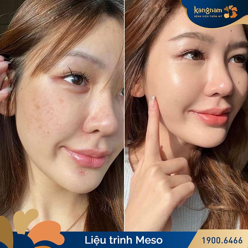 Thực hiện liệu trình tiêm meso sẽ giúp làn da của khách hàng có sự thay đổi hiệu quả