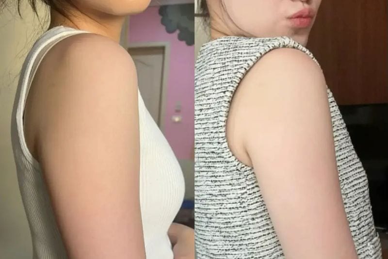 Trước và sau khi tiêm botox thon gọn bắp tay