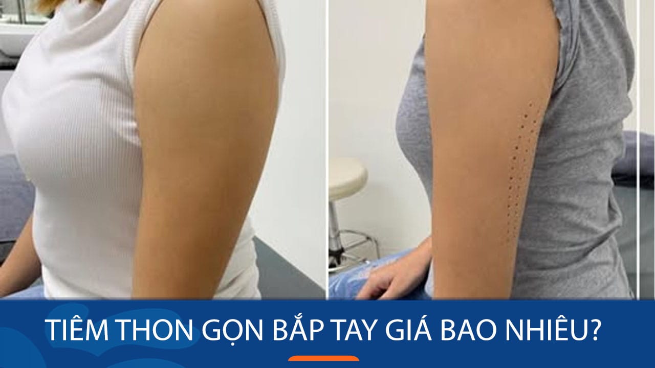 Tiêm thon gọn bắp tay giá bao nhiêu? cần lưu ý điều gì