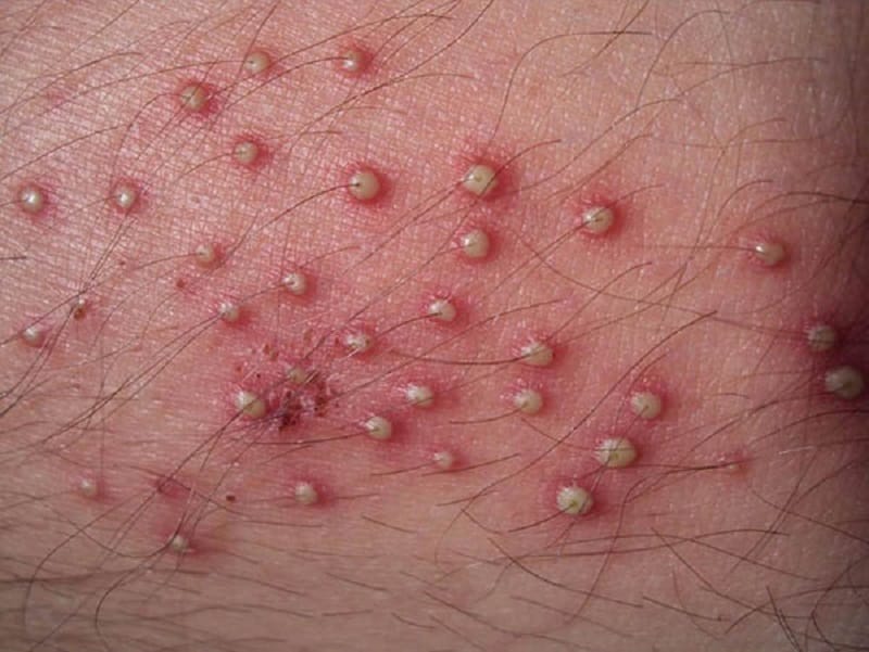 Khi triệt lông sớm có thể gây tổn thương cho da