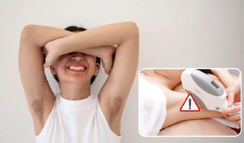 Không nên cho trẻ trong tuổi dậy thì triệt lông vĩnh viễn