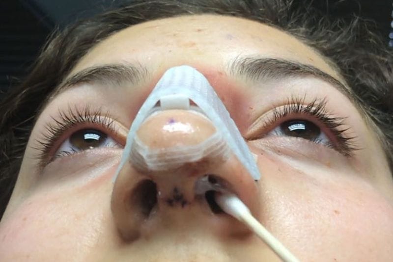 Dịch sau nâng mũi là hiện tượng tích tụ chất lỏng dưới da tại vùng mũi sau phẫu thuật