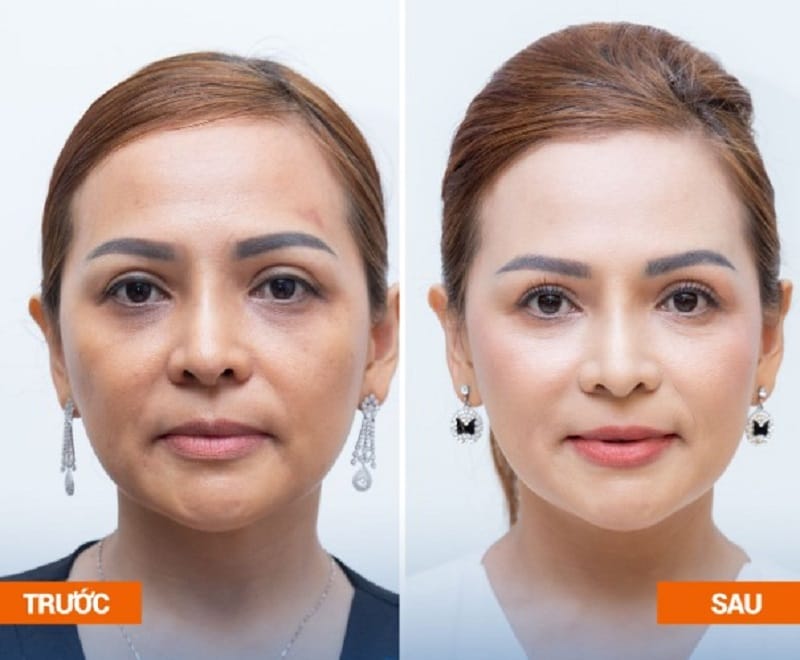 Da mặt căng bóng, săn chắc, cải thiện tình trạng chảy xệ, lão hóa