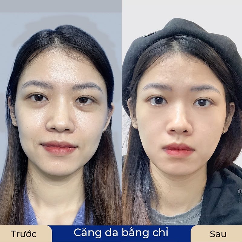 Sau khi căng chỉ tại Kangnam khách hàng rất hài lòng về hiệu quả