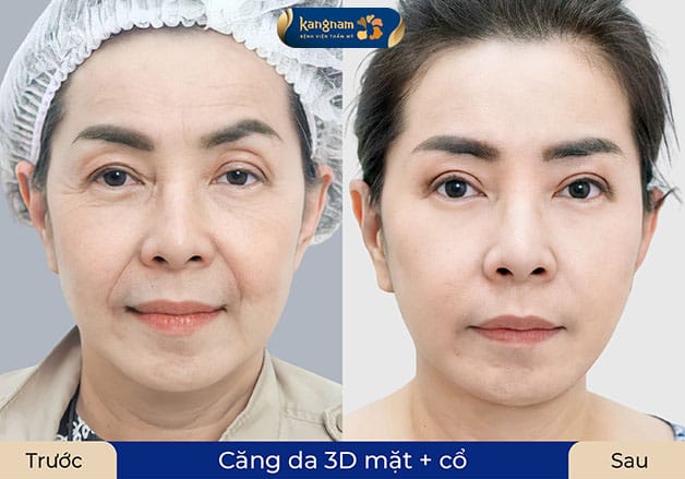 Trẻ hóa đến 10 tuổi chỉ sau một lần căng da