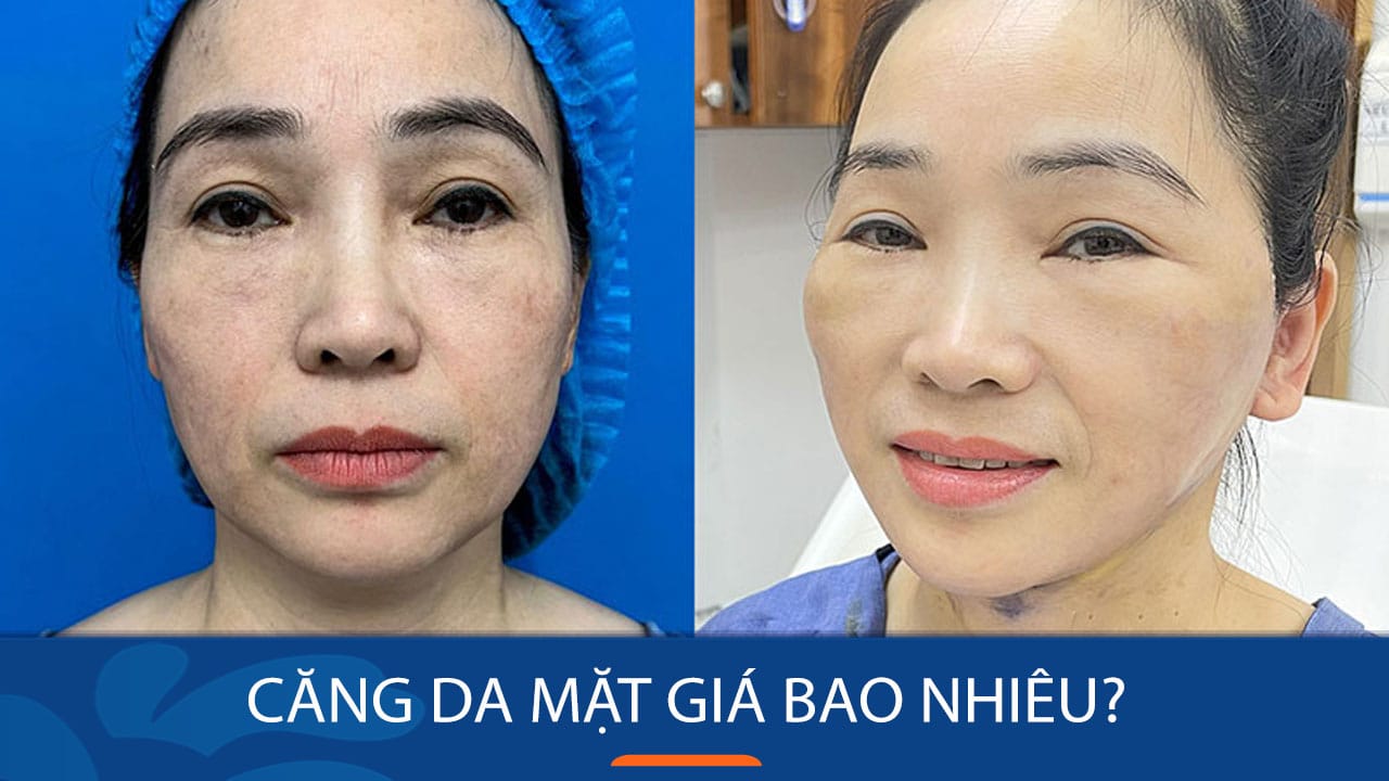 Căng da mặt giá bao nhiêu? Bảng giá chính xác và mới nhất
