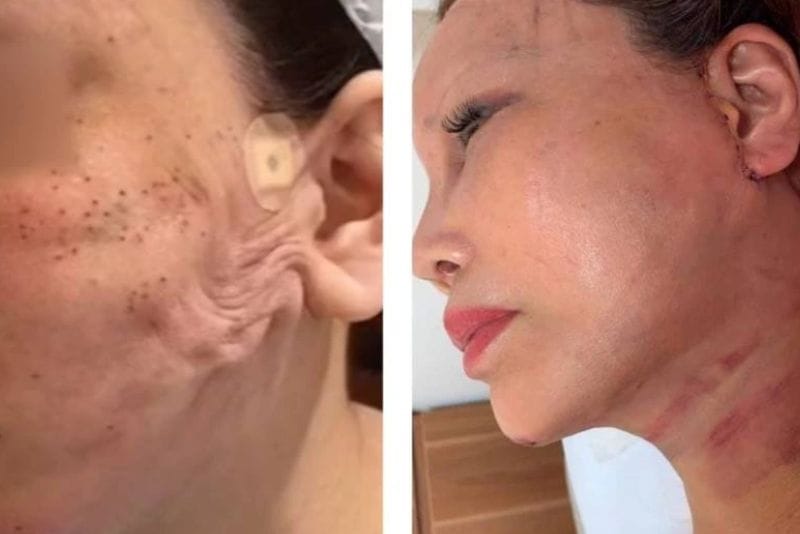 Biến chứng căng da mặt tại cơ sở giá rẻ