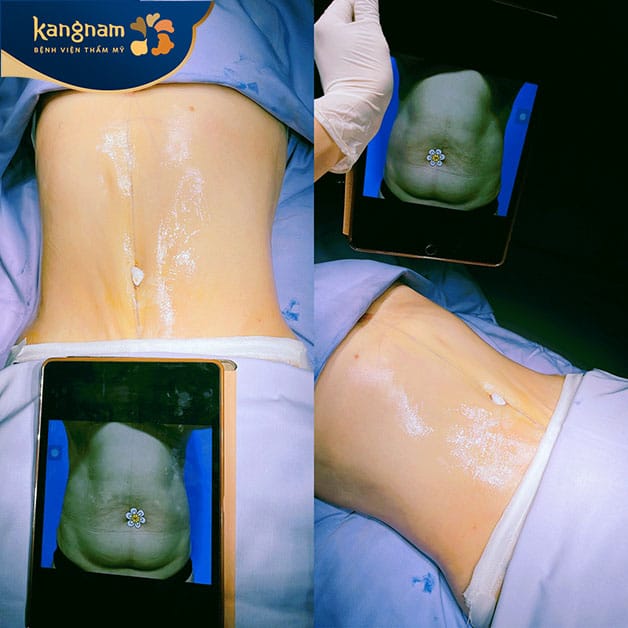 Chi phí chăm sóc sau giảm mỡ