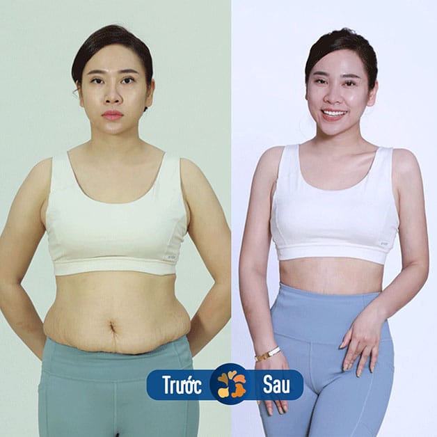 Chi phí hút mỡ bụng