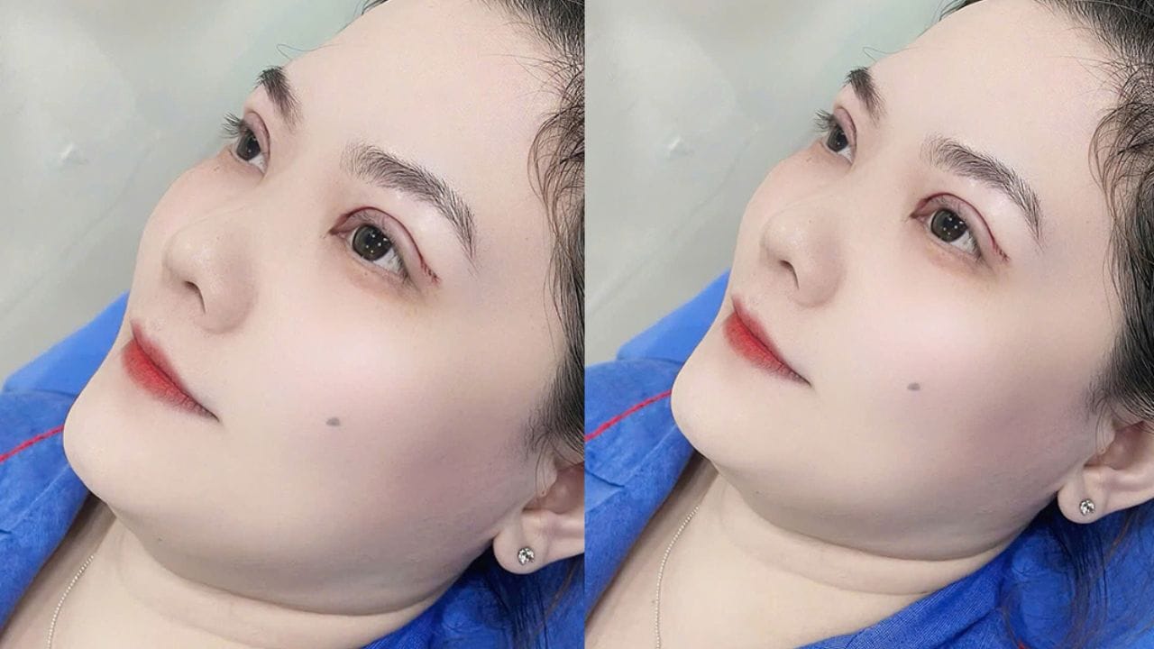 Cắt mí có đau không? Cần lưu ý điều gì sau khi cắt mí