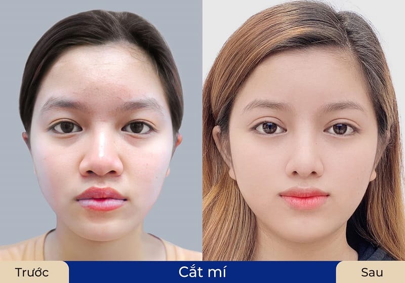 Mí mắt phục hồi đẹp tự nhiên sau cắt mí và biết cách chăm sóc