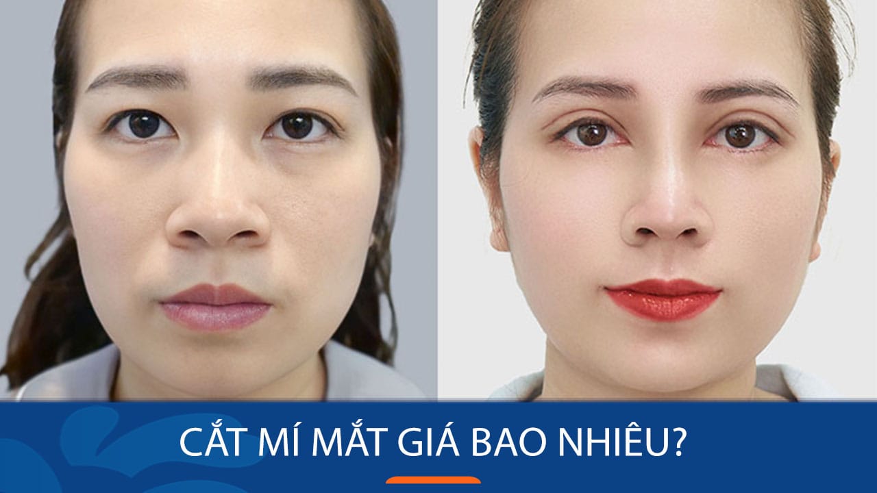 Cắt mí mắt giá bao nhiêu? Yếu tố khiến giá khác nhau tại các nơi