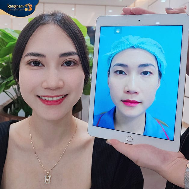 Cắt mí duy trì kết quả lâu nhưng không vĩnh viễn