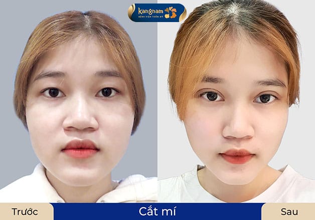 So sánh hiệu quả thẩm mỹ