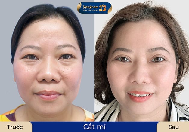 Kangnam cung cấp gói bảo hành lâu dài sau cắt mí