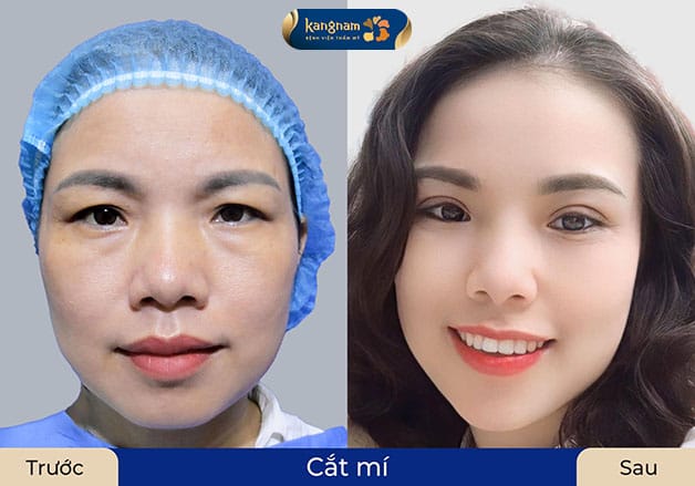 Đôi mắt rõ mí giúp gương mặt hài hòa và sắc nét hơn.