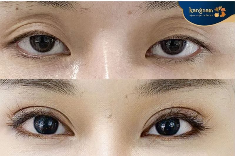 Cấy mỡ hốc mắt cần thực hiện lại sau 6 tháng đến 1 năm