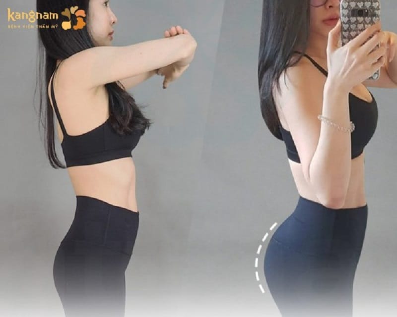 Thời gian duy trì sau cấy mỡ mông tương đối dài