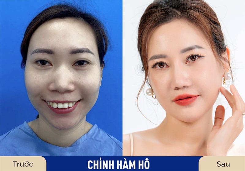 Hàm hô càng nặng và sai lệch nhiều thì chi phí càng tăng