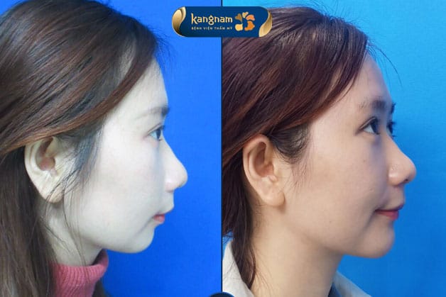 Khách hàng trước và sau khi thực hiện phẫu thuật trượt cằm