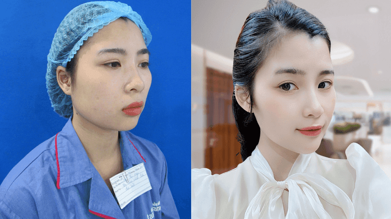 Cằm thon gọn, hài hòa gương mặt sau khi trượt cằm thành công