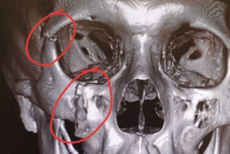 Ảnh mô tả gãy xương gò má