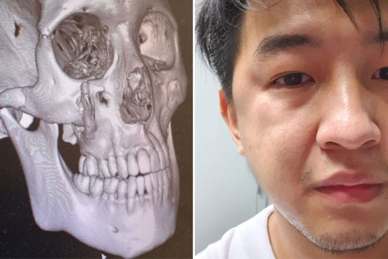 Gãy xương gò má lành sau 6-8 tuần