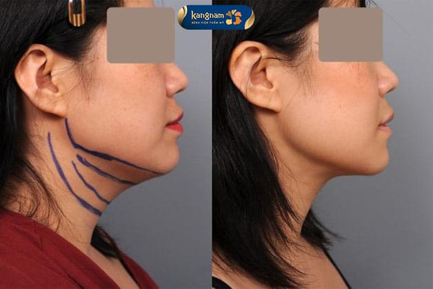 Cằm thon gọn tức thì, vùng da giảm mỡ săn chắc