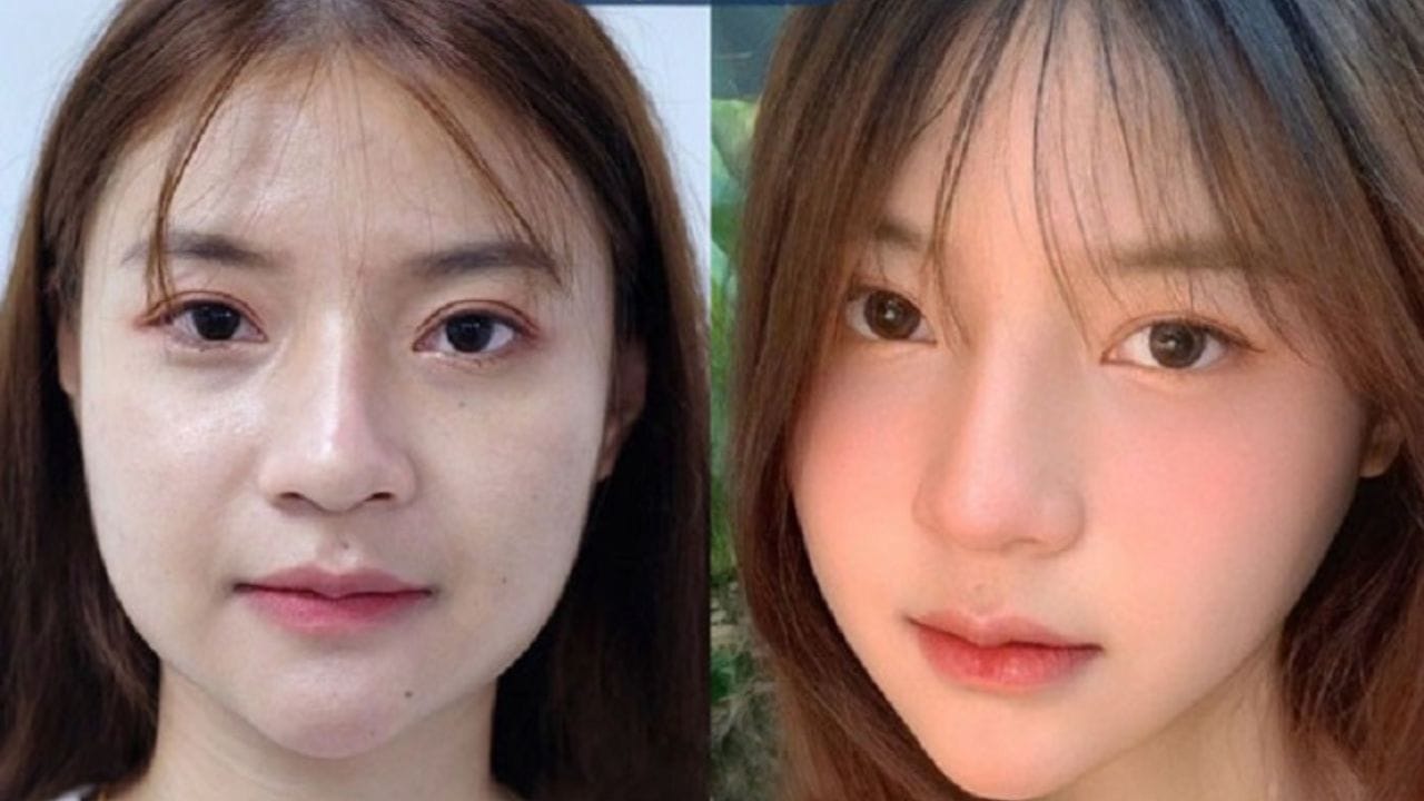 Gọt cằm giá bao nhiêu? mức giá bạn cần biết